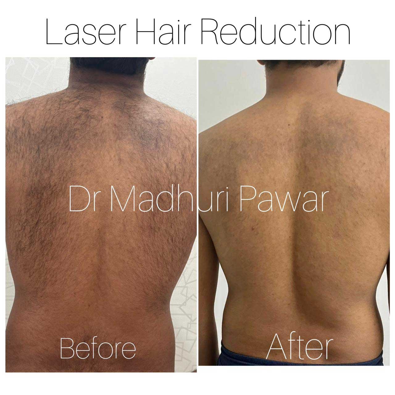 laser-hair-reduction